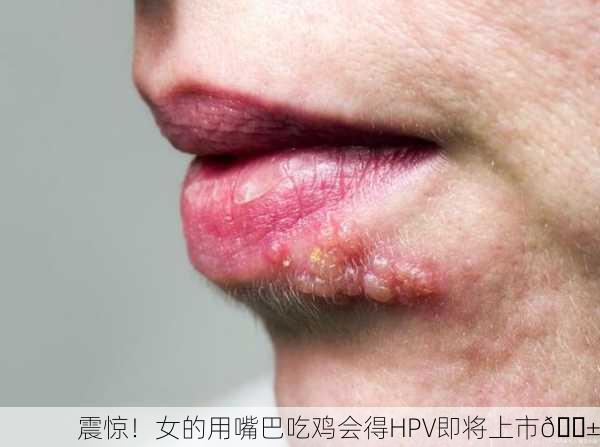 震惊！女的用嘴巴吃鸡会得HPV即将上市😱