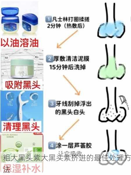 粗大黑头紫大黑头紫挤进的最佳处理方法