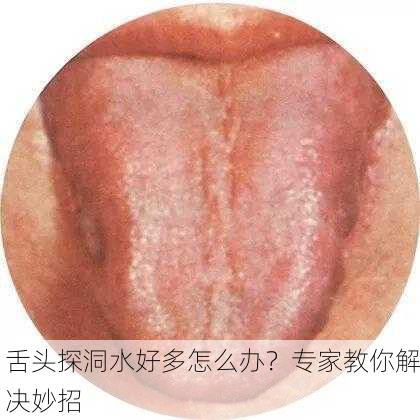 舌头探洞水好多怎么办？专家教你解决妙招