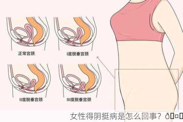 女性得阴挺病是怎么回事？🤔