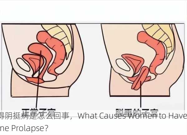 女性得阴挺病是怎么回事，What Causes Women to Have Uterine Prolapse？