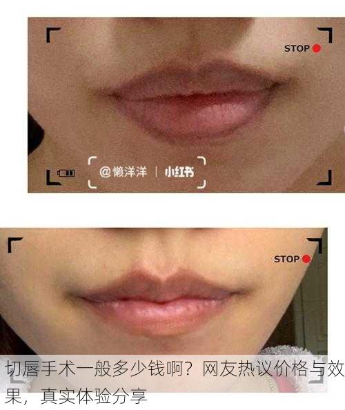 切唇手术一般多少钱啊？网友热议价格与效果，真实体验分享