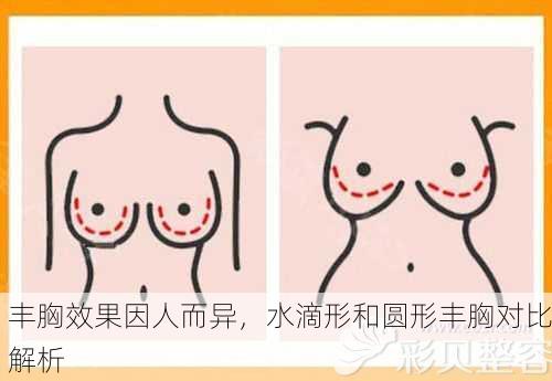 丰胸效果因人而异，水滴形和圆形丰胸对比解析