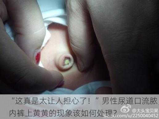 “这真是太让人担心了！”男性尿道口流脓，内裤上黄黄的现象该如何处理？