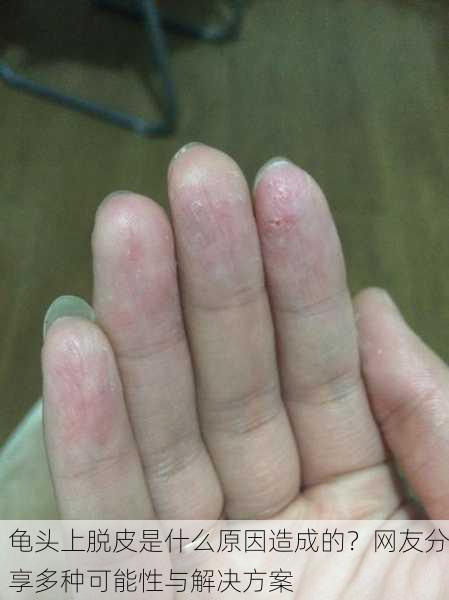 龟头上脱皮是什么原因造成的？网友分享多种可能性与解决方案