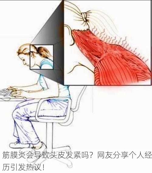 筋膜炎会导致头皮发紧吗？网友分享个人经历引发热议！